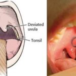 Can You Get Strep Throat Without Tonsils?