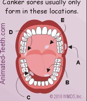 canker sores location