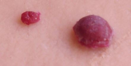 cherry angioma pics