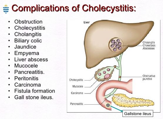 cholecystitis complications