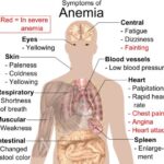 Autoimmune Hemolytic Anemia