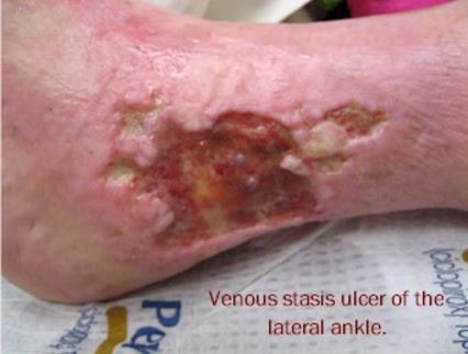 venous stasis ulcer lateral ankle