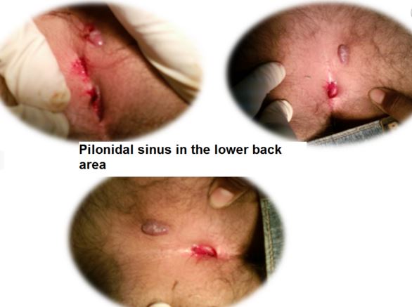 pilonidal sinus in lower back area