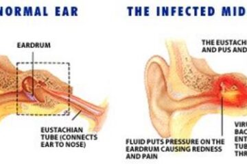 Middle ear infection Anatomy