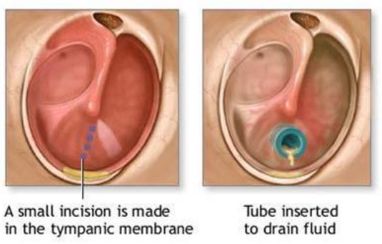 Middle ear infection pus drianage surgery incision tympanic membraneMiddle ear infection pus drianage surgery incision tympanic membrane