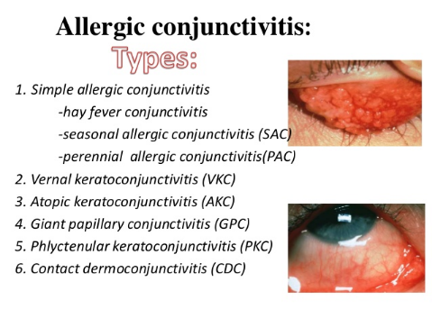 Giant Papillary Conjunctivitis Picture 3