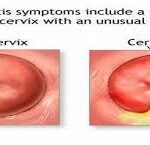 cervicitis