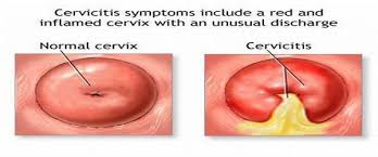 cervicitis Picture 2