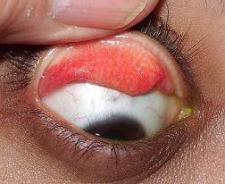 Giant Papillary Conjunctivitis Picture 2