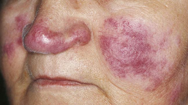 Affected lymph nodes: the cause is Lupus.