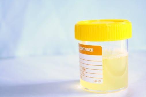 Cloudy Urine Picture 1