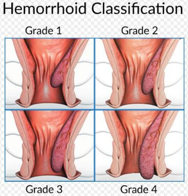 Hemorrhoids classification grades 1 2 3 4
