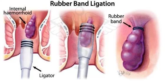 Rubber band ligation for hemorrhoid