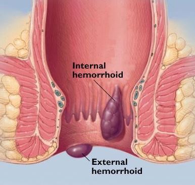 Hemorrhoid external internal