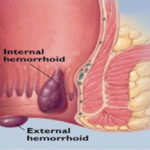 Thrombosed Hemorrhoid – Is it Dangerous?