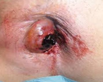 Thrombosed Hemorrhoid Bleeding external
