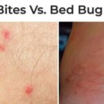 Flea Bites Vs Bed Bug Bites, How to Get Rid of Flea Bites?