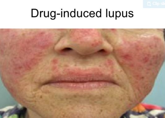Drug induced lupus butter fly rash