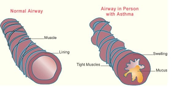 asthma airway